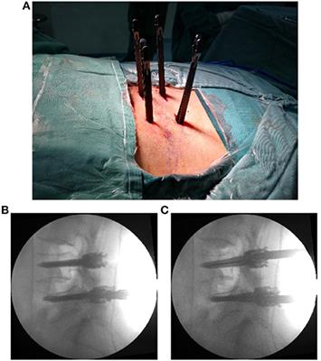 A Modified Endoscopic Transforaminal Lumbar Interbody Fusion Technique: Preliminary Clinical Results of 96 Cases